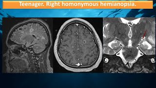 Teenager Homonymous hemianopsia [upl. by Yran]