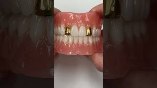 Process Denture with Gold Incisors dental smile teeth shorts shortvideo gold dentures [upl. by Nnek725]