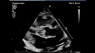 Basic echocardiography심장 초음파 기본 Bicuspid aortic valve dysplastic aortic valve [upl. by Ymiaj468]