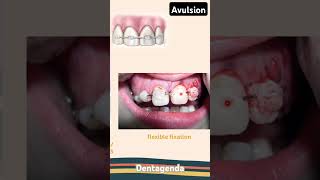 Avulsion management for permanent teeth [upl. by Carlotta751]