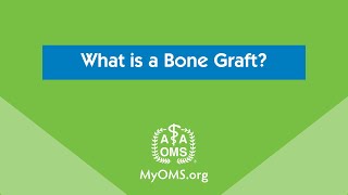 What is a Bone Graft [upl. by Elin]