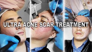 ULTRA COMBINATION TREATMENT AGAINST ACNE SCARS [upl. by Enneirdna]