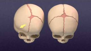 Craniosynostosis  Mayo Clinic [upl. by Krystle172]