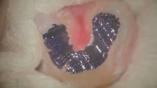 Lower 2nd Molar Intentional Replantation 18 [upl. by Wivinia230]