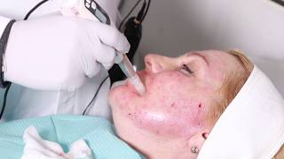 Mesotherapy and dermapen microneedling Before and after Makeover True Reality 22 [upl. by Leisam741]