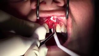 Extraction 9 with GBRSocket Grafting Membrane Use and Bone Fill II [upl. by Solana390]