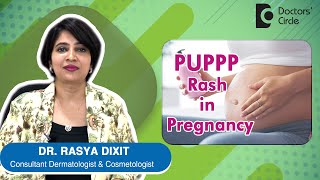 PUPPP Rash in Pregnancy Causes Symptoms Prevention amp Treatment  Dr Rasya Dixit  Doctors Circle [upl. by Repinuj696]