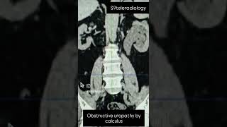 Obstructive uropathy ureteric calculus kidneystone ctscan renalfailure s9teleradiology [upl. by Bonnette69]