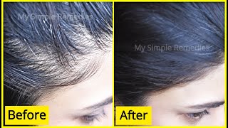 100 Effective Secret Method To Regrow Hair From Roots  Hair Regrowth Treatment [upl. by Wilser775]