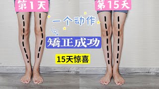 【我的O型腿矫正成功了】15天每日15分钟【一个动作针对性练习】 Oshaped leg correctionOne action persists for 15 days [upl. by Mirabella]