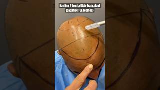 Hair line amp Frontal Hair Transplant with Sapphire FUE Method at Cara Clinic Mumbai [upl. by Shulman]