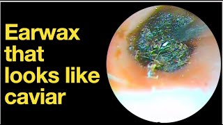 Earwax that looks like caviar ear wax removal  ear cleaning  ASMR  relaxation  relax [upl. by Arateehc]