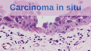 What is Carcinoma in situ  Pathology mini tutorial [upl. by Akiraa866]