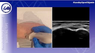 How to locate the Lisfranc ligament of the foot on ultrasound [upl. by Marilee]