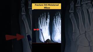 FRACTURE 5th Metatarsal Bone Xray Foot radiographerusn radiography xray bones [upl. by Dorrie]