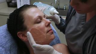 How does the IPL Photofacial work Watch and learn  Seiler Skin [upl. by Ennoirb736]