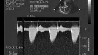 echocardiogrammultiple rhabdomyoma tumor cw doppler [upl. by Leacock]