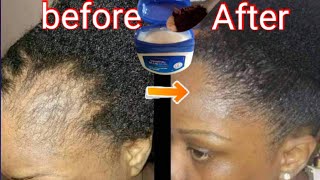 Mix Vaseline and Coffee for Extraordinary Hair Growth [upl. by Syl]