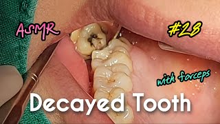 ASMR Decayed Wisdom Tooth Extraction [upl. by Saalocin]