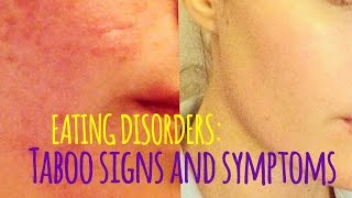 Eating Disorders Signs amp Symptoms We Dont Talk About [upl. by Guerra174]