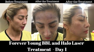 Day 1  Forever BBL Laser and Halo Laser Treatment [upl. by Amadas]