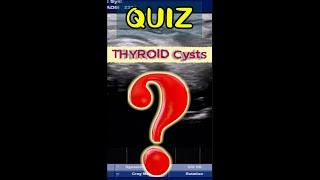 QUIZ  Thyroid Cyst [upl. by Naic]