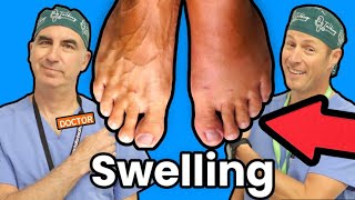 Foot and Ankle Swelling What Causes It [upl. by Burn]