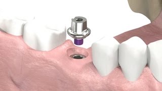 SIC invent Dental Implant  Prosthetic Animation Single Crown Closed Tray Technique [upl. by Domenico14]