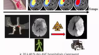 AVC Ischémique en 2014 [upl. by Odlo370]