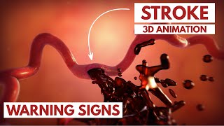 How to Recognize a Stroke  3D Animation [upl. by Harsho]