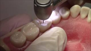 Tutorial on Class I Cavity Preparation Amalgam Restoration  DENTALKART [upl. by Barta]