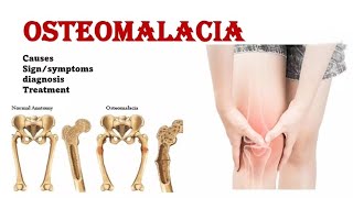 Osteomalacia  Rickets  Osteomalacia vs Osteoporosis  sign amp symptoms  management [upl. by Ahsitak]