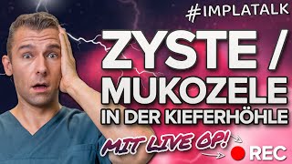 Zyste  Mukozele in der Kieferhöhle 🆘 Was tun Wir erklären die Ursachen amp Therapie inkl Live OP [upl. by Kira]