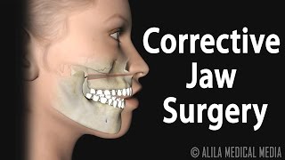 Corrective Jaw Orthognathic Surgery Animation [upl. by Cousins]