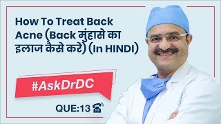 How To Treat Back Acne Back मुंहासे का इलाज कैसे करेAskDrDc Ep 13  ClearSkin Pune  In HINDI [upl. by Ttelracs]