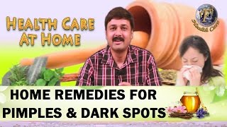 HOME REMEDIES FOR PIMPLES ACNE AND DARK SPOTSII कील मुहासों और काले धब्बो का घरेलू उपचार II [upl. by Irrac330]