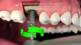 Straumann® TLX Implant System Step by Step [upl. by Aihsenod]