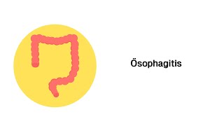 Speiseröhrenentzündung Ösophagitis  Erkrankungen des Verdauungssystems [upl. by Omiseno]