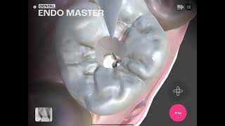 Maxillary First Molar Access OpenDental EndoMaster [upl. by Custer]