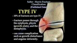 Salter Harris Fracture Classification  Everything You Need To Know  Dr Nabil Ebraheim [upl. by Alegnaoj935]