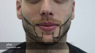 Beard Transplant Beard to Beard Transplant Hairline Clinic [upl. by Slotnick]