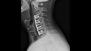 ACDF Bone Fusion Rates Recovery Timeline 2024 Four level Cervical Fusion [upl. by Sansone]