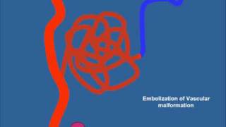 AVM Embolization [upl. by Ennaecarg]