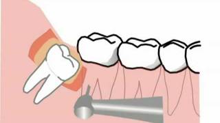 spezielle Komplikationen bei der Weisheitszahnentfernung neue Version [upl. by Ellah322]
