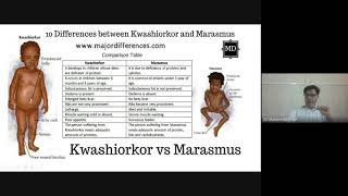 Kwashiorkor and Marasmus What’s the Difference [upl. by Amsirhc]