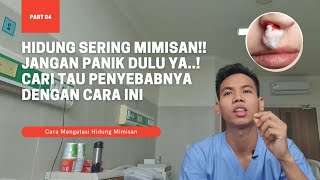 HIDUNG BERDARAH⁉️ JANGAN PANIK  BERIKUT CARA MENGATASI HIDUNG BERDARAH DIRUMAH [upl. by Cirala]