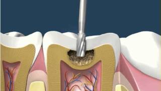 Dental Fillings White Amalgam 1 [upl. by Eiuqcaj]