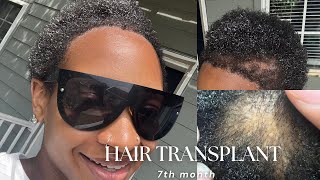 7 MONTH HAIR TRANSPLANT REVIEW TURKEY LONGEVITA [upl. by Rodmur]