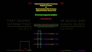 Электрокардиография  Атриовентрикулярная Блокада Первой Степени И Блокада Правой Ножки Пучка Гиса [upl. by Naoj]