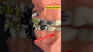 Mini Screw Braces  Orthodontics treatments [upl. by Call]